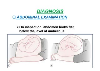 DIAGNOSIS
 ABDOMINAL EXAMINATION
On inspection abdomen looks flat
below the level of umbelicus
 
