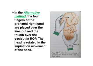  In the Alternative
method, the four
fingers of the
pronated right hand
are placed over the
sinciput and the
thumb over the
occiput in ROP. The
head is rotated in the
supination movement
of the hand.
 