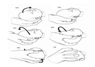Occipital posterior position .pdf 🙏🙏🙏