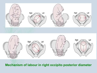 Mechanism of labour in right occipito posterior diameter
 