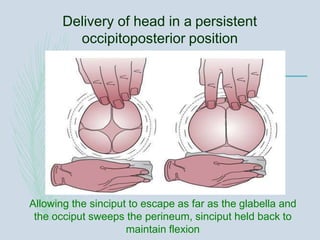Delivery of head in a persistent
occipitoposterior position
Allowing the sinciput to escape as far as the glabella and
the occiput sweeps the perineum, sinciput held back to
maintain flexion
 