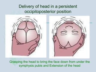 Delivery of head in a persistent
occipitoposterior position
Grasping the head to bring the face down from under the
symphysis pubis and Extension of the head
 
