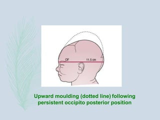 Upward moulding (dotted line) following
persistent occipito posterior position
 