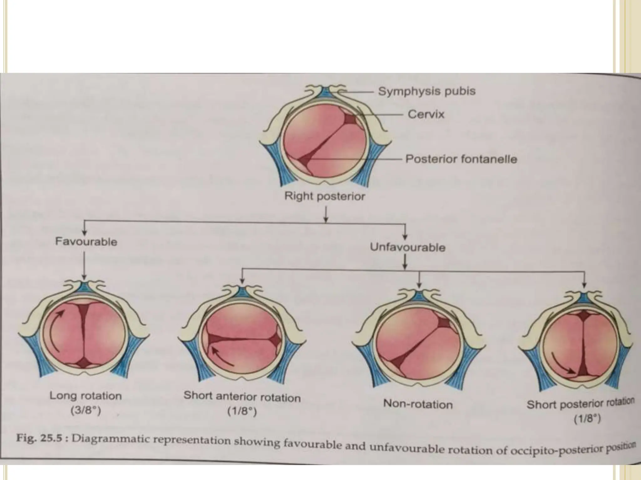 Occipito posterior position 20.06.2020 final.ppt