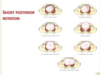 Posterior Rotation Treatment Occipito posterior position 20.06.2020 final.ppt