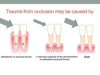 Trauma from occlusion may be caused by
alterations in occlusal forces a reduced capacity of the periodontium
to withstand occlusal forces
Both
 