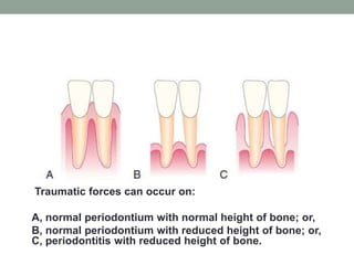 Traumatic forces can occur on:
A, normal periodontium with normal height of bone; or,
B, normal periodontium with reduced height of bone; or,
C, periodontitis with reduced height of bone.
 