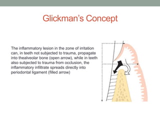 Glickman’s Concept
The inflammatory lesion in the zone of irritation
can, in teeth not subjected to trauma, propagate
into thealveolar bone (open arrow), while in teeth
also subjected to trauma from occlusion, the
inflammatory infiltrate spreads directly into
periodontal ligament (filled arrow)
 