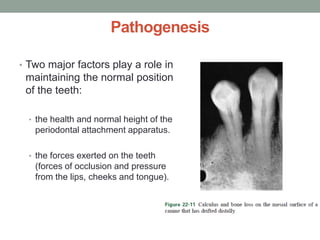 Pathogenesis
• Two major factors play a role in
maintaining the normal position
of the teeth:
• the health and normal height of the
periodontal attachment apparatus.
• the forces exerted on the teeth
(forces of occlusion and pressure
from the lips, cheeks and tongue).
 