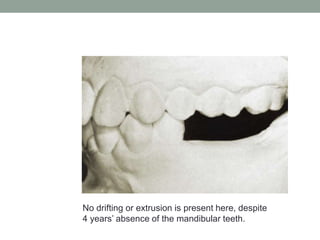 No drifting or extrusion is present here, despite
4 years’ absence of the mandibular teeth.
 