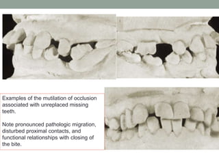 Examples of the mutilation of occlusion
associated with unreplaced missing
teeth.
Note pronounced pathologic migration,
disturbed proximal contacts, and
functional relationships with closing of
the bite.
 