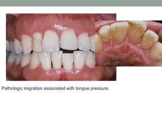 Pathologic migration associated with tongue pressure.
 