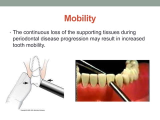 Mobility
• The continuous loss of the supporting tissues during
periodontal disease progression may result in increased
tooth mobility.
 