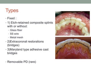 Types
• Fixed :
• 1) Etch-retained composite splints
with or without:
• Glass fiber
• SS wire
• Metal mesh
• 2)Extracoronal restorations
(bridges)
• 3)Maryland type adhesive cast
bridges
• Removable PD (rare)
 