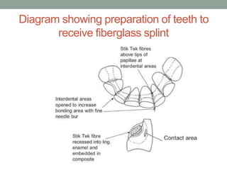 Diagram showing preparation of teeth to
receive fiberglass splint
 