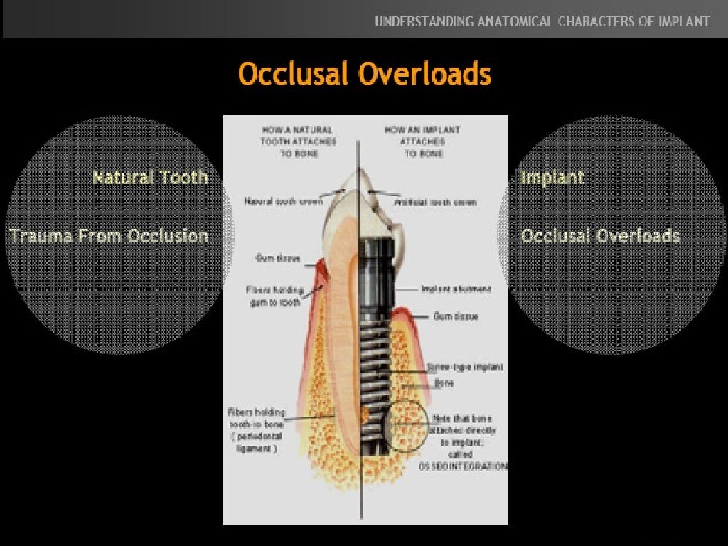 Occlusal Considerations For Implant Supported Prostheses Implant Pro…