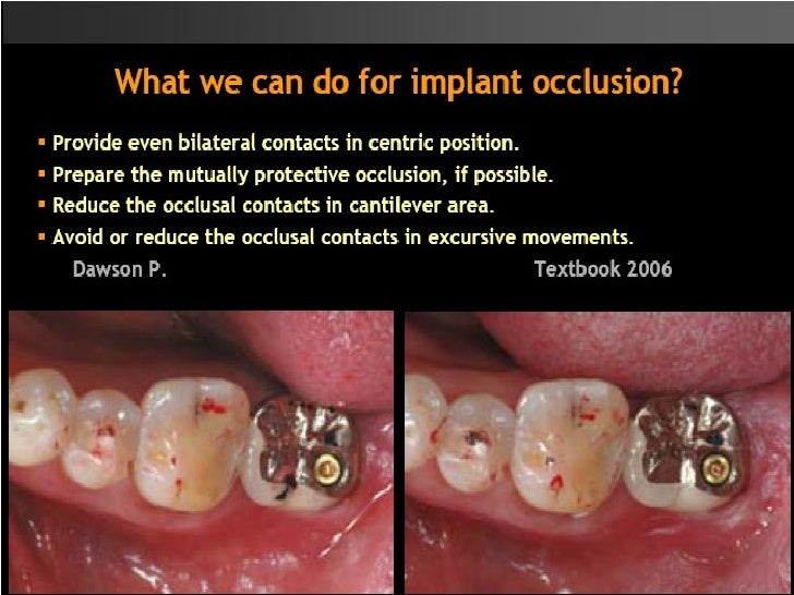 Occlusal Considerations For Implant Supported Prostheses Implant Pro…