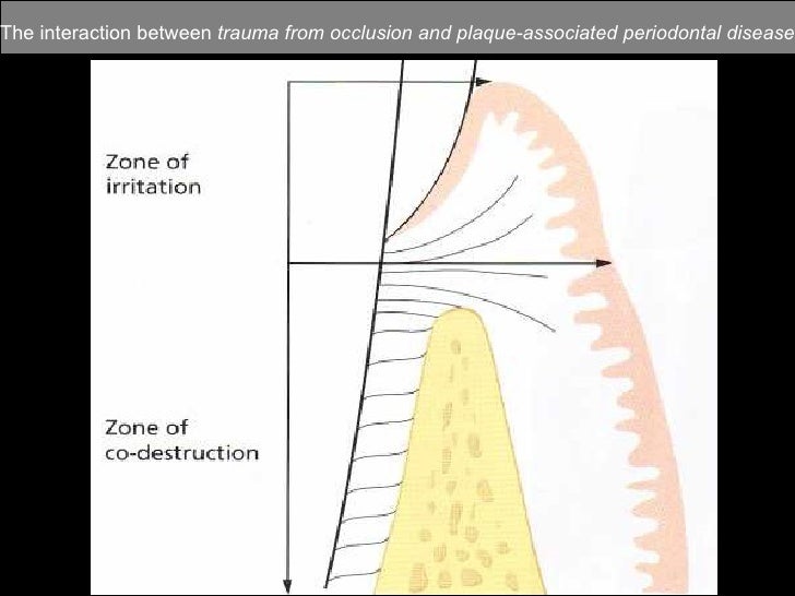 Occlusal Considerations For Implant Supported Prostheses Implant Pro…