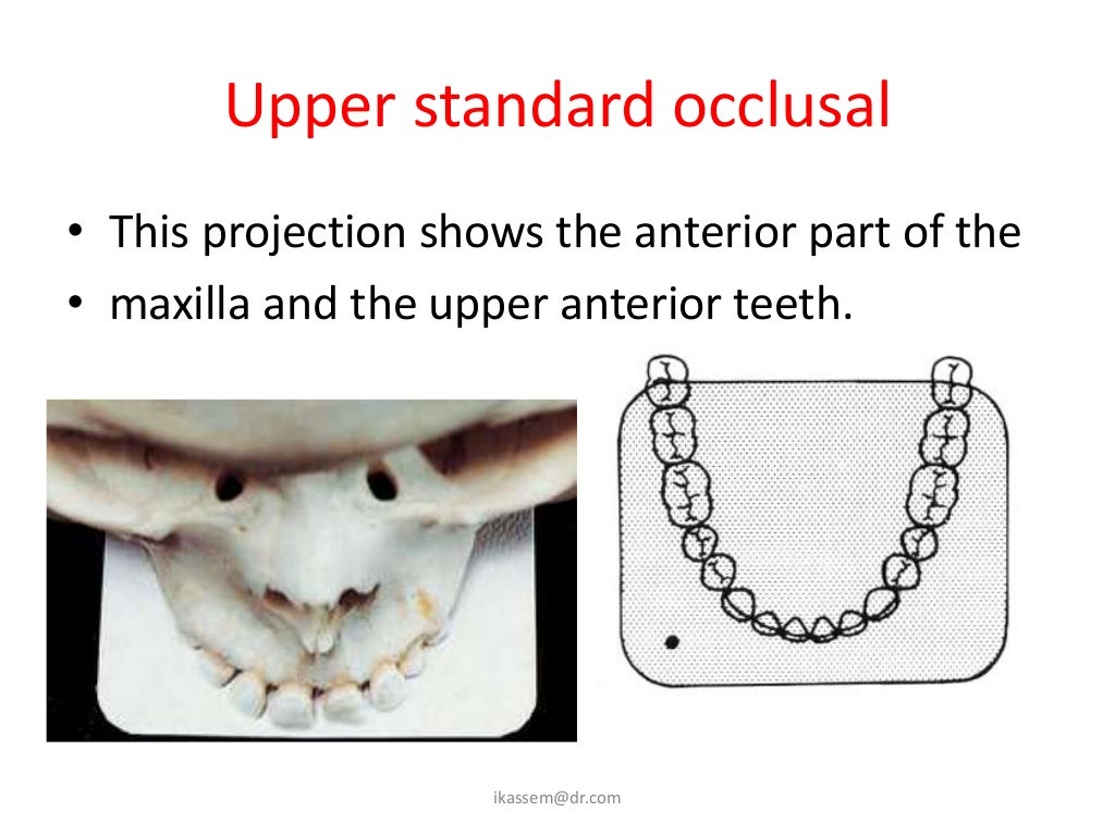 Occlusal max