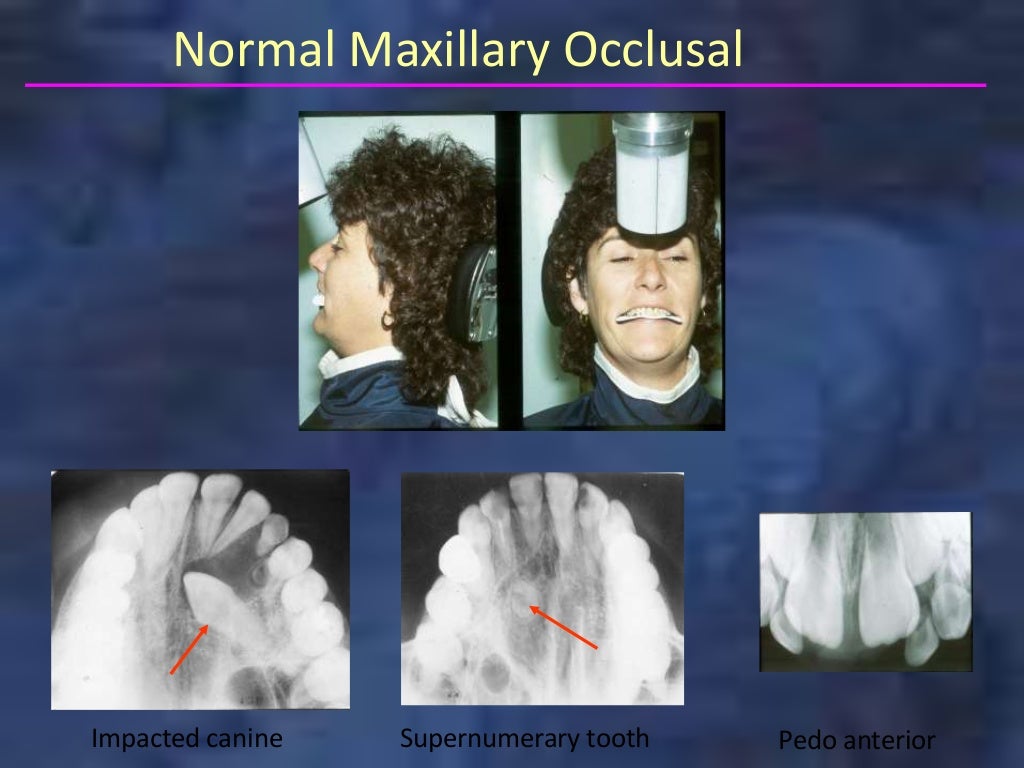 Occlusal max