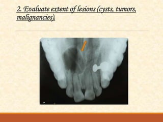 2. Evaluate extent of lesions (cysts, tumors,
malignancies).
 