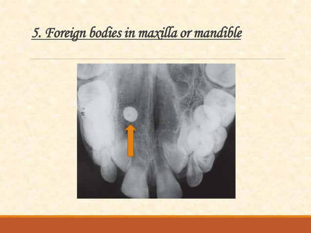 Occlusal radiography | PPTX | Dental Health | Diseases and Conditions