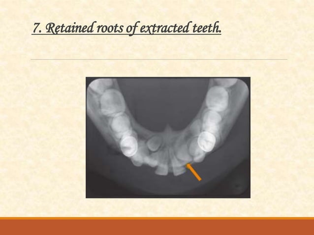 Occlusal radiography | PPTX | Dental Health | Diseases and Conditions