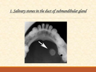 1. Salivary stones in the duct of submandibular gland
 