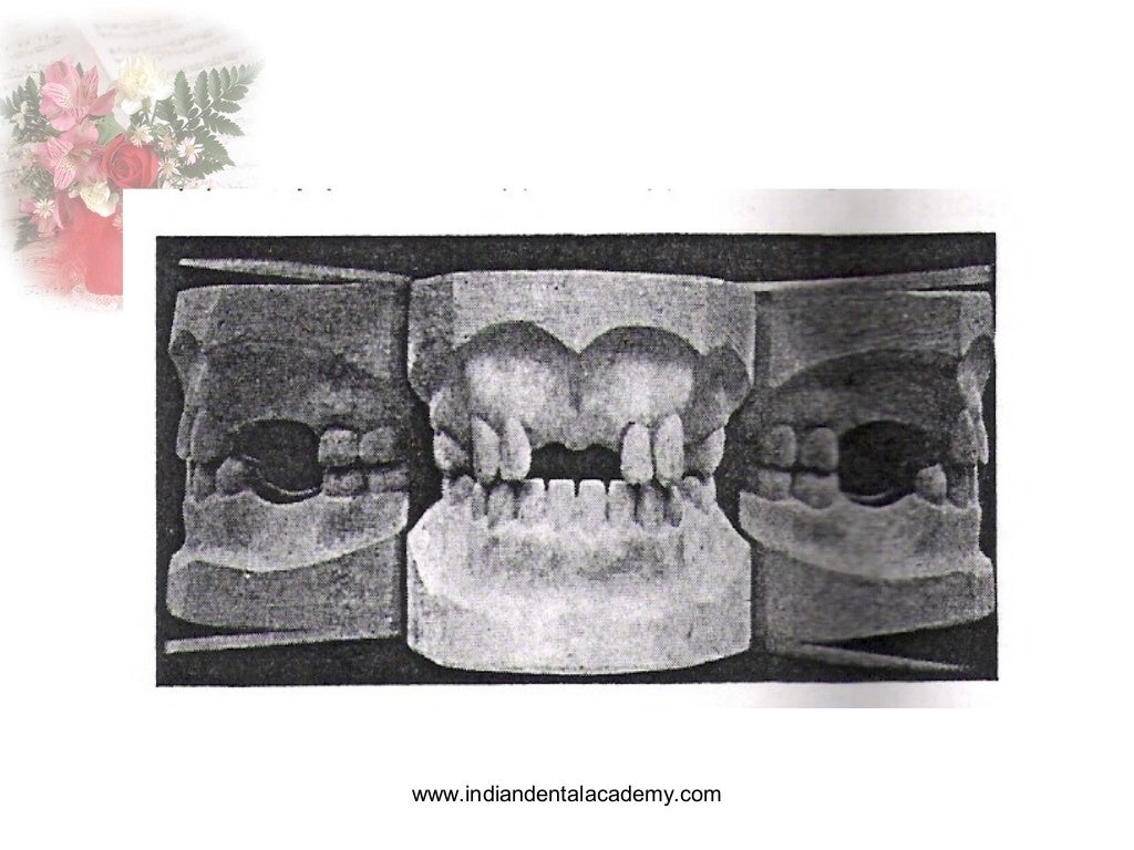 Occlusal registration in removable partial denture / orthodontic semi…
