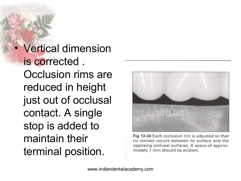 Occlusal registration in removable partial denture / orthodontic semi…