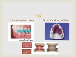 
Interocclusal wax record Bit rim and record base
 
