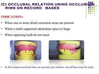 Occlusal Record Rpd Occlusal relationship in_rpd__prostho_ | PPT