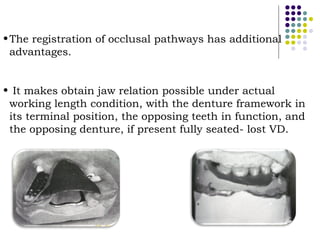 Occlusal Support Rpd Occlusal relationship in_rpd__prostho_ | PPT