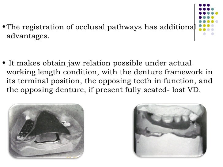 Occlusal relationship in_rpd__prostho_