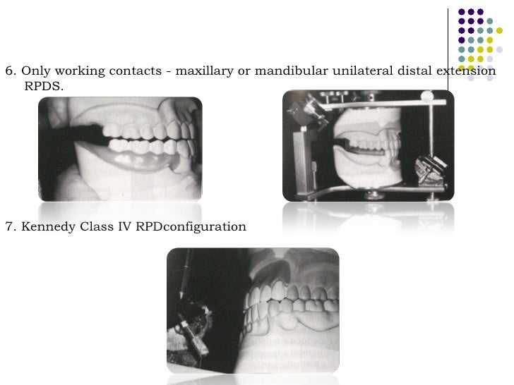 Occlusal relationship in_rpd__prostho_