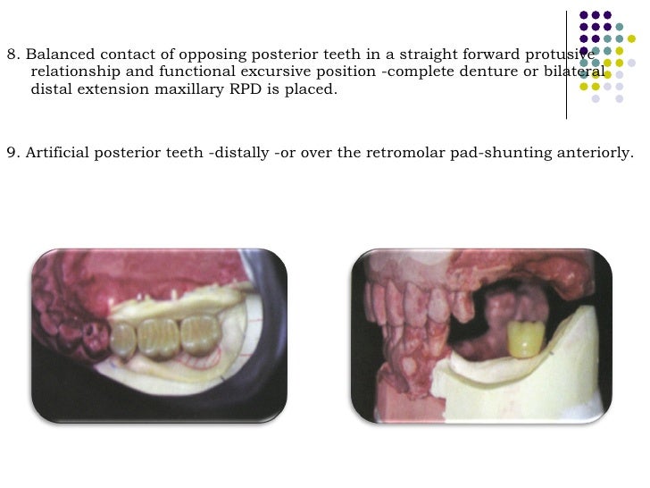 Occlusal relationship in_rpd__prostho_