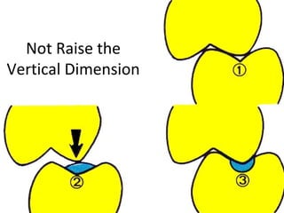 Not Raise the
Vertical Dimension
 
