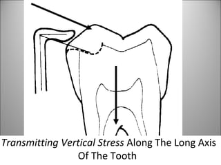 Transmitting Vertical Stress Along The Long Axis
Of The Tooth
 