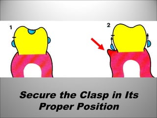 Secure the Clasp in Its
Proper Position
 