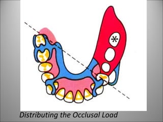 Distributing the Occlusal Load
 