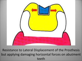 Resistance to Lateral Displacement of the Prosthesis
but applying damaging horizontal forces on abutment
teeth
 