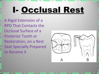 A Rigid Extension of a
RPD That Contacts the
Occlusal Surface of a
Posterior Tooth or
Restoration, on a Rest
Seat Specially Prepared
to Receive it
I- Occlusal Rest
 