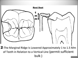 Rest Seat
2-The Marginal Ridge Is Lowered Approximately 1 to 1.5 Mm
of Teeth in Relation to a Vertical Line (permit sufficient
bulk )
1
m
m
 