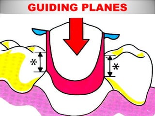 GUIDING PLANES
 