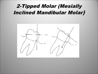 2-Tipped Molar (Mesially
Inclined Mandibular Molar)
 