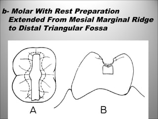 b- Molar With Rest Preparation
Extended From Mesial Marginal Ridge
to Distal Triangular Fossa
 