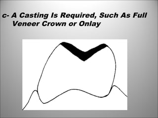 c- A Casting Is Required, Such As Full
Veneer Crown or Onlay
 