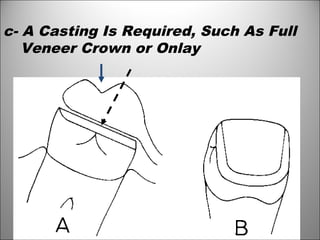 c- A Casting Is Required, Such As Full
Veneer Crown or Onlay
 