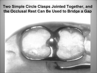 Two Simple Circle Clasps Jointed Together, and
the Occlusal Rest Can Be Used to Bridge a Gap
Between Teeth
 