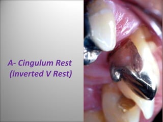A- Cingulum Rest
(inverted V Rest)
 
